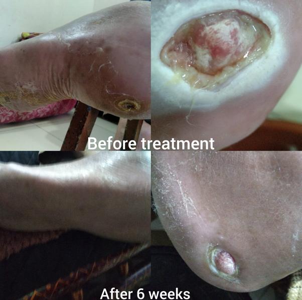 Gangrene Treatment